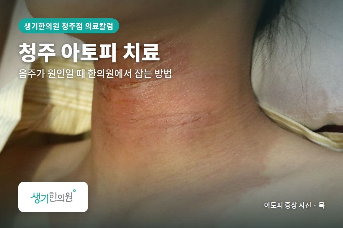 목 부위 아토피 증상 사진과 문구 「청주 아토피 치료, 음주가 원인일 때 한의원에서 잡는 방법 · 생기한의원 청주점」
