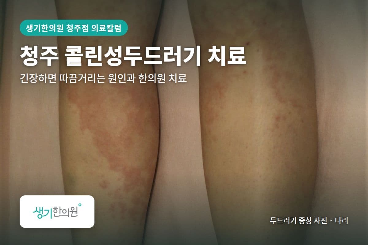 다리 두드러기 증상 사진과 문구 「청주 콜린성두드러기 치료, 긴장하면 따끔거리는 원인과 한의원 치료 · 생기한의원 청주점」