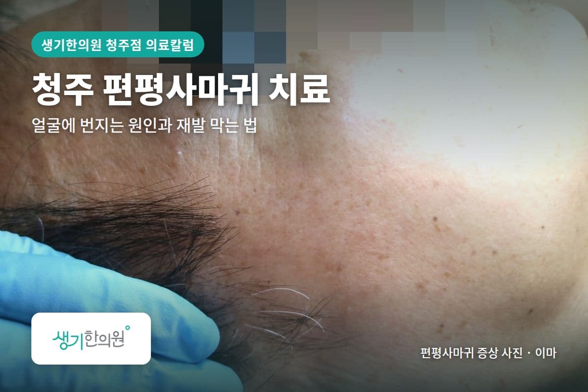 이마 편평사마귀 증상 사진과 문구 「청주 편평사마귀 치료, 얼굴에 번지는 원인과 재발 막는 법 · 생기한의원 청주점」
