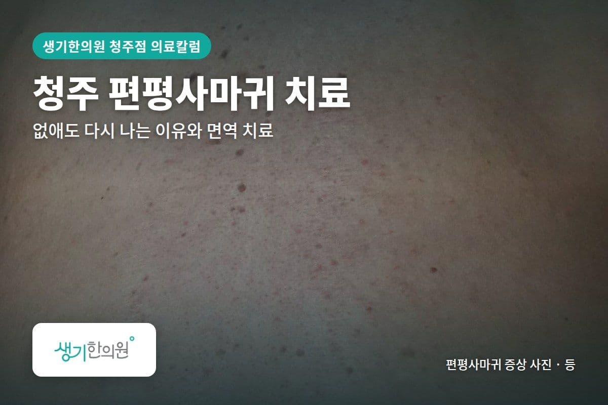 등 부위 편평사마귀 증상 사진과 문구 「청주 편평사마귀 치료, 없애도 다시 나는 이유와 면역 치료 · 생기한의원 청주점」
