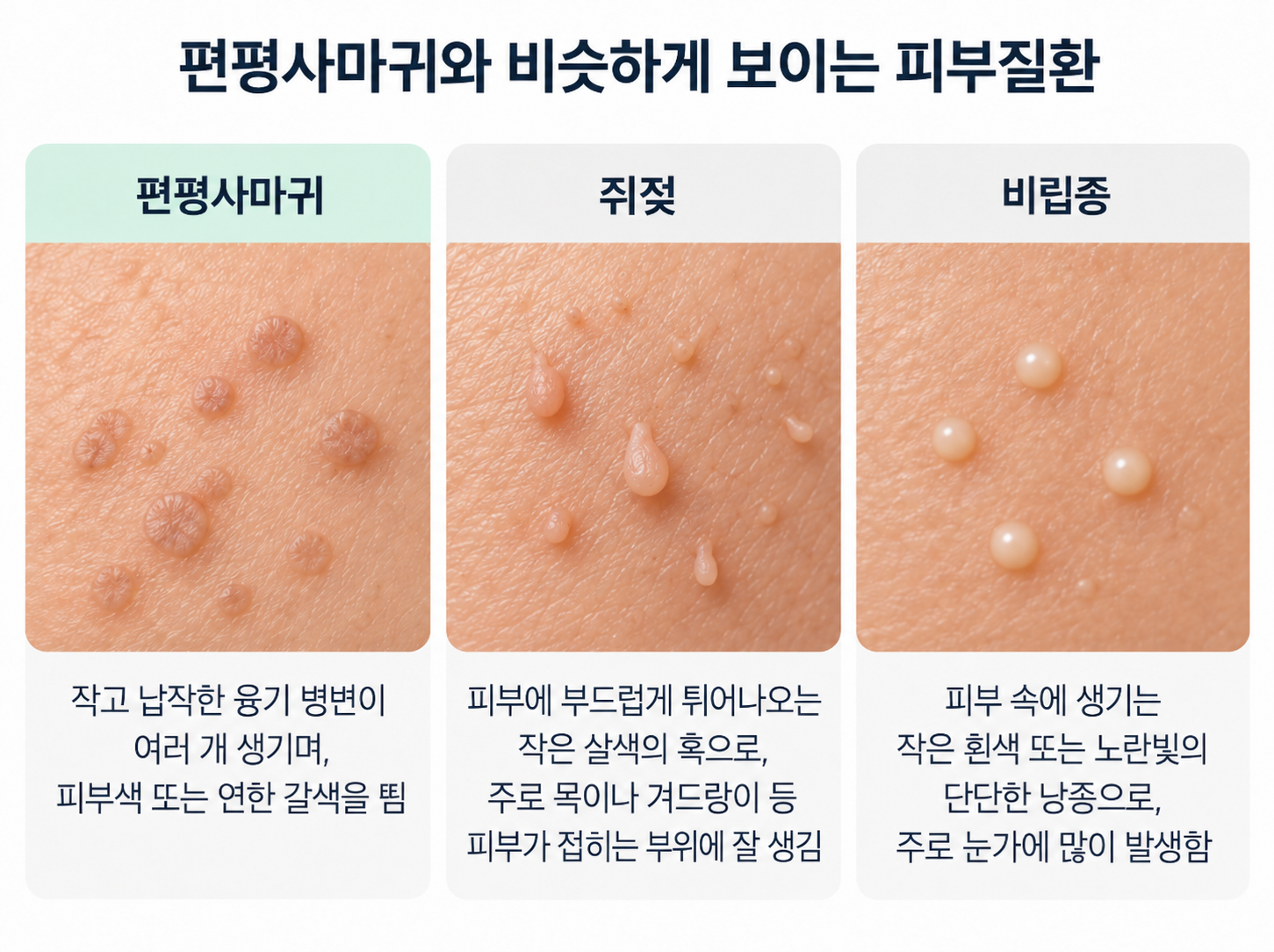 편평사마귀와 비슷한 피부질환. 쥐젓, 비립종