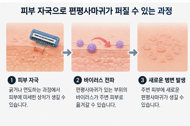 편평사마귀 피부 자극 전파