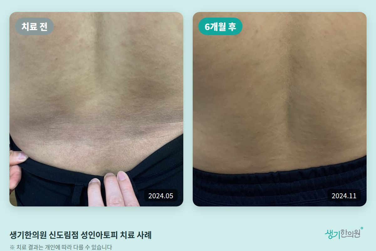 생기한의원 신도림점 성인아토피 치료 전(2024.05)과 6개월 후(2024.11) 비교 사진