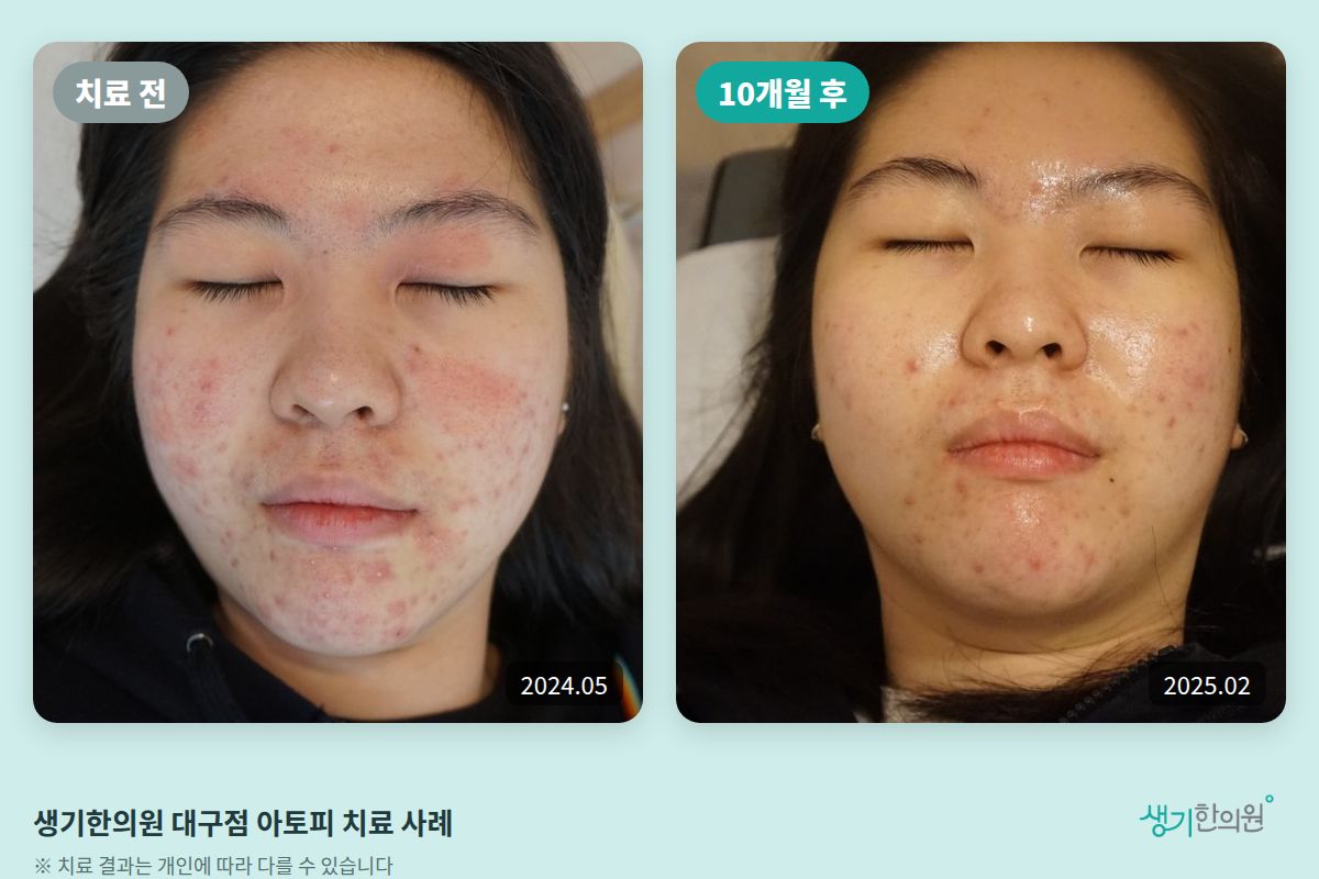 생기한의원 대구점 아토피 치료 전(2024.05)과 10개월 후(2025.02) 비교 사진