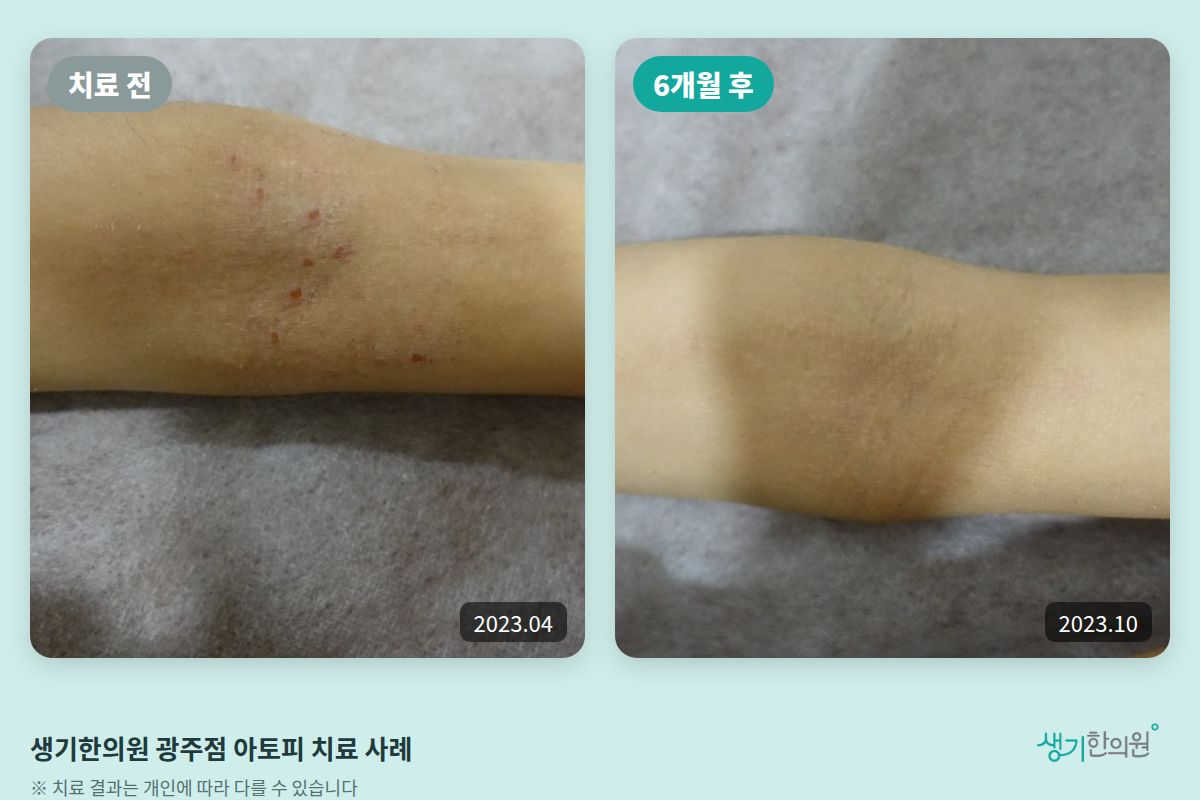 생기한의원 광주점 아토피 치료 전(2023.04)과 6개월 후(2023.10) 비교 사진