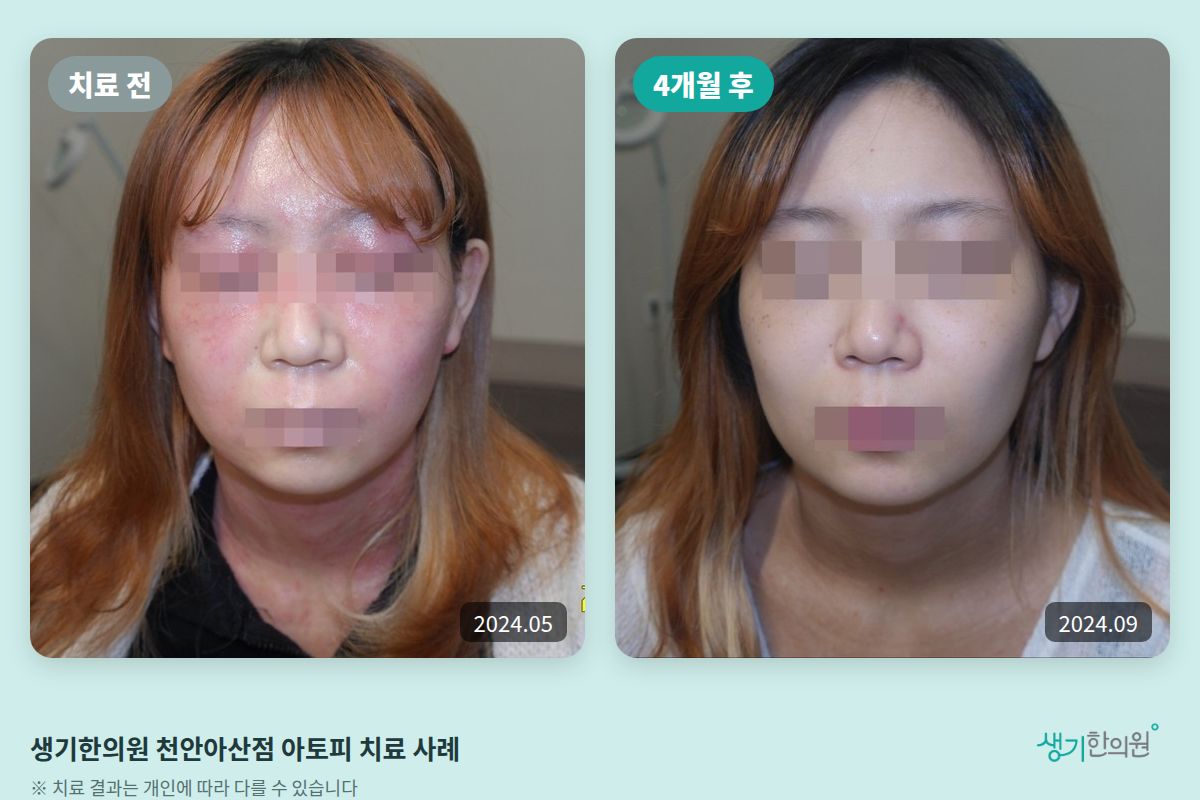 생기한의원 천안아산점 아토피 치료 전(2024.05)과 4개월 후(2024.09) 비교 사진