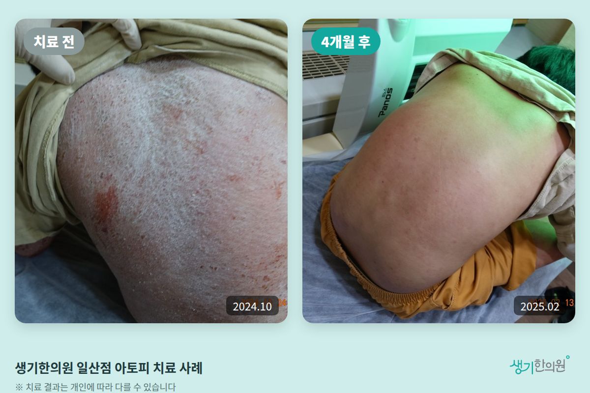 생기한의원 일산점 아토피 치료 전(2024.10)과 4개월 후(2025.02) 비교 사진