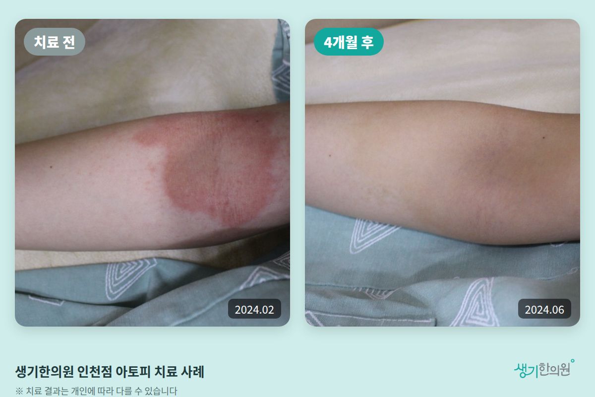 생기한의원 인천점 아토피 치료 전(2024.02)과 4개월 후(2024.06) 비교 사진