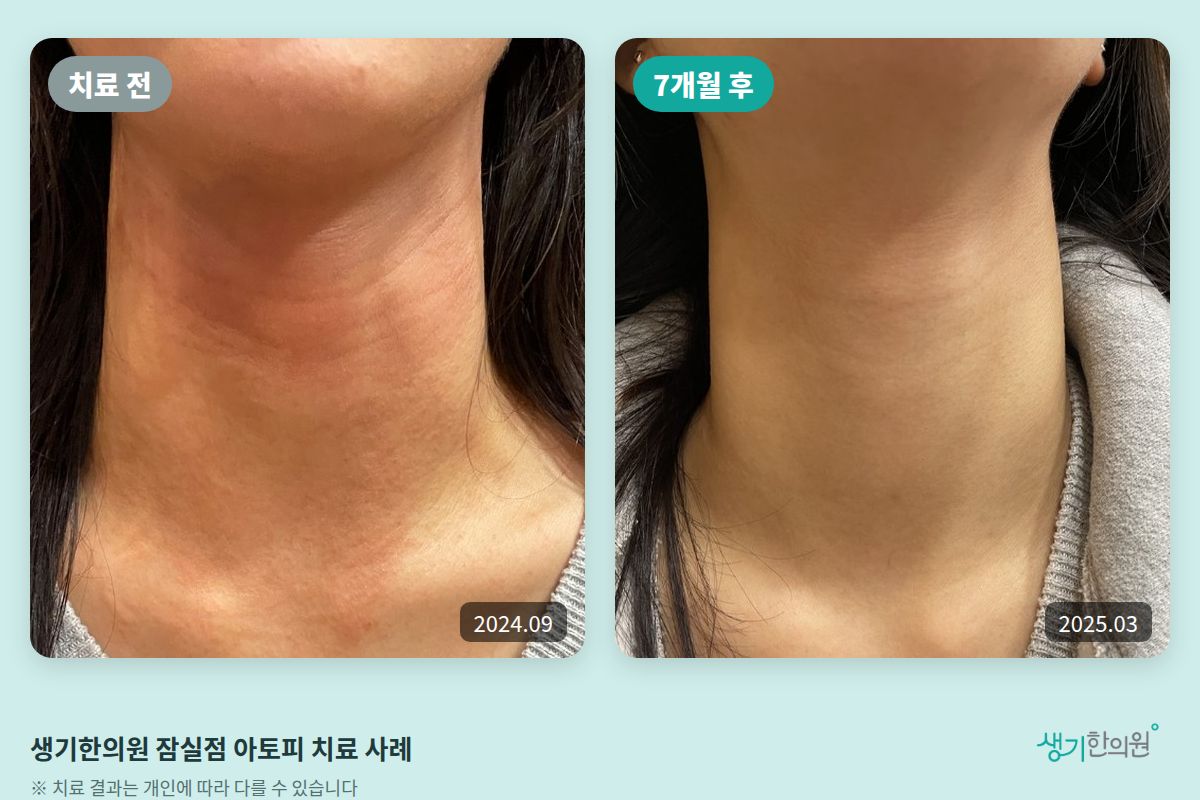 생기한의원 잠실점 아토피 치료 전(2024.09)과 7개월 후(2025.03) 비교 사진