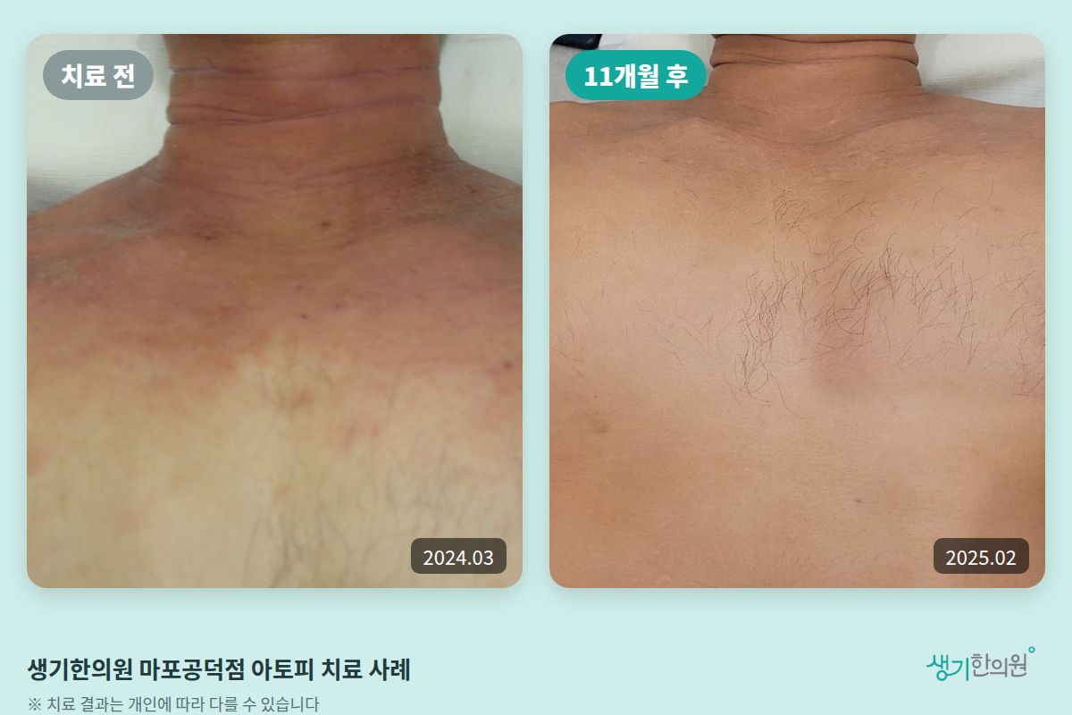 생기한의원 마포공덕점 아토피 치료 전(2024.03)과 11개월 후(2025.02) 비교 사진
