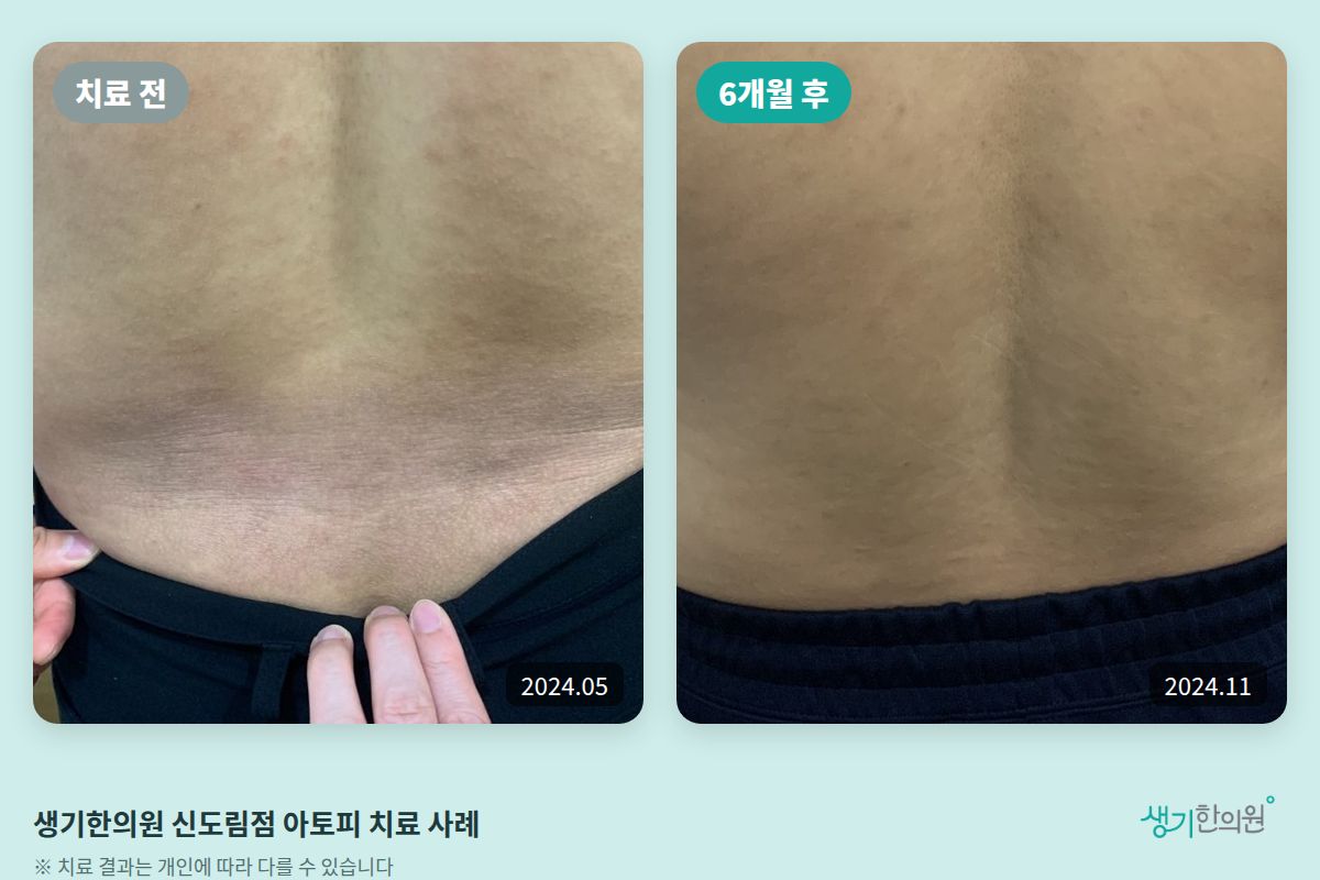 생기한의원 신도림점 아토피 치료 전(2024.05)과 6개월 후(2024.11) 비교 사진