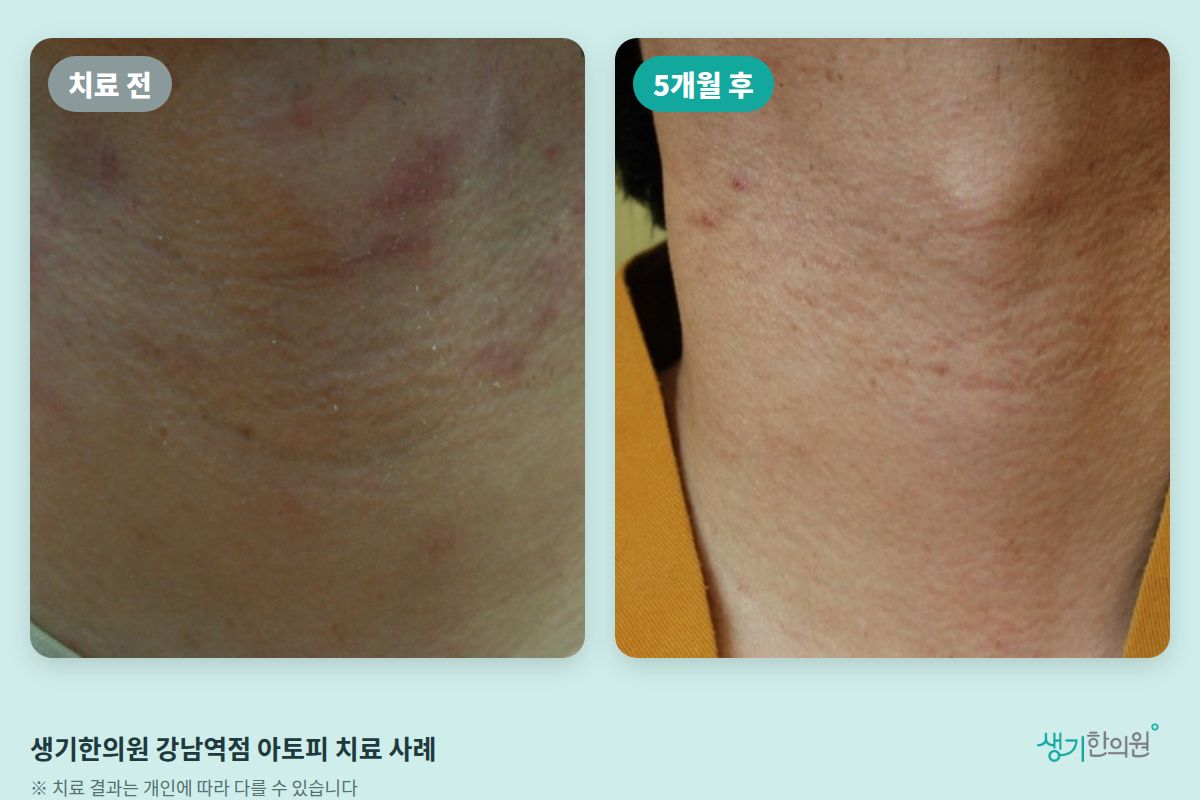 생기한의원 강남역점 아토피 치료 전과 5개월 후 비교 사진