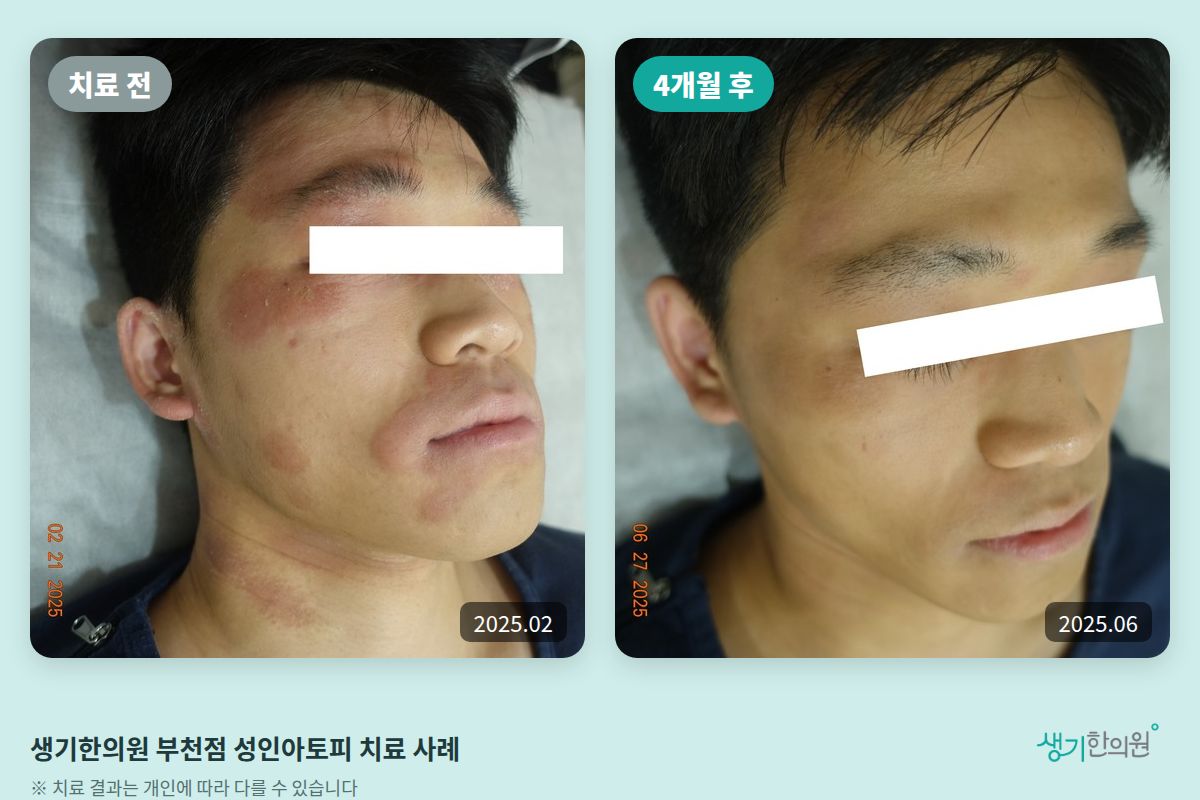 생기한의원 부천점 성인아토피 치료 전(2025.02)과 4개월 후(2025.06) 비교 사진
