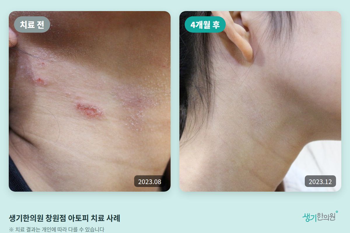 생기한의원 창원점 아토피 치료 전(2023.08)과 4개월 후(2023.12) 비교 사진