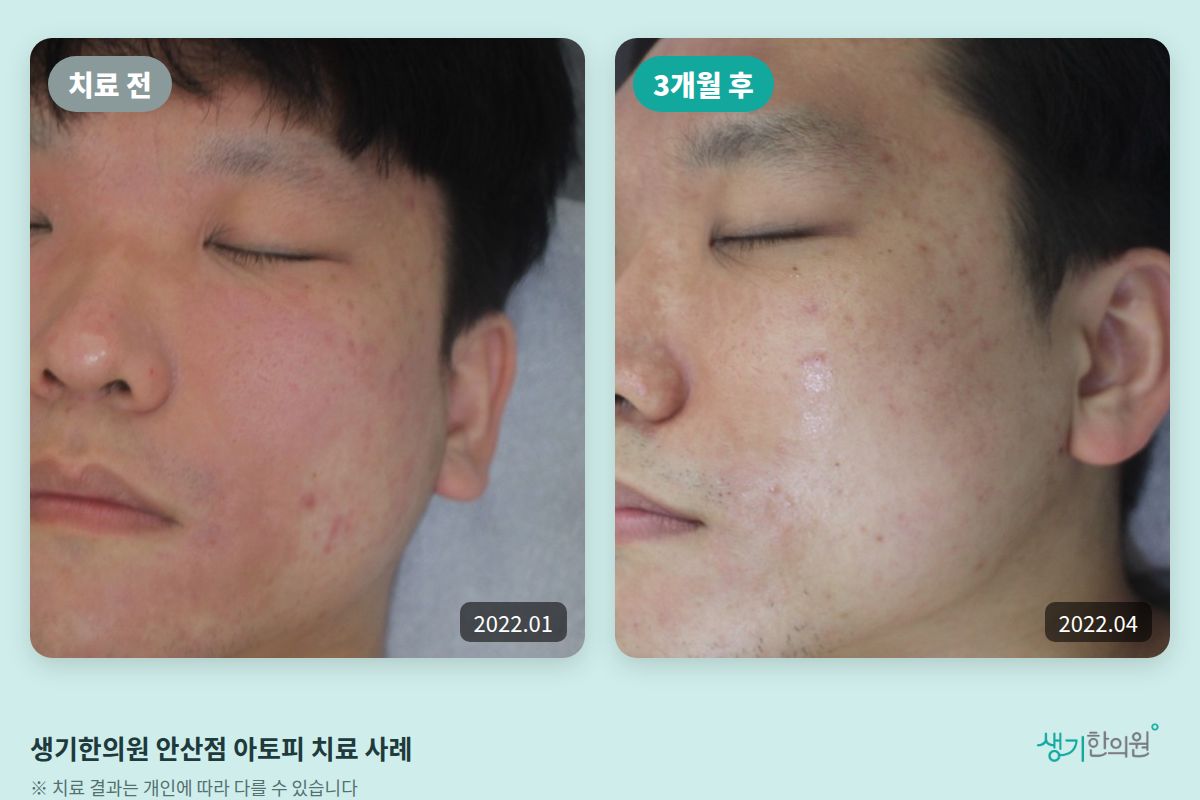 생기한의원 안산점 아토피 치료 전(2022.01)과 3개월 후(2022.04) 비교 사진
