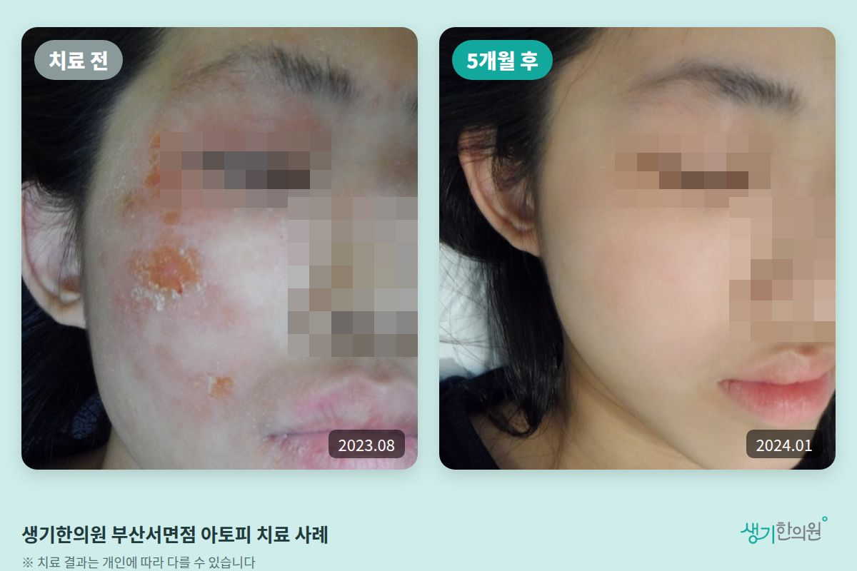 생기한의원 부산서면점 아토피 치료 전(2023.08)과 5개월 후(2024.01) 비교 사진