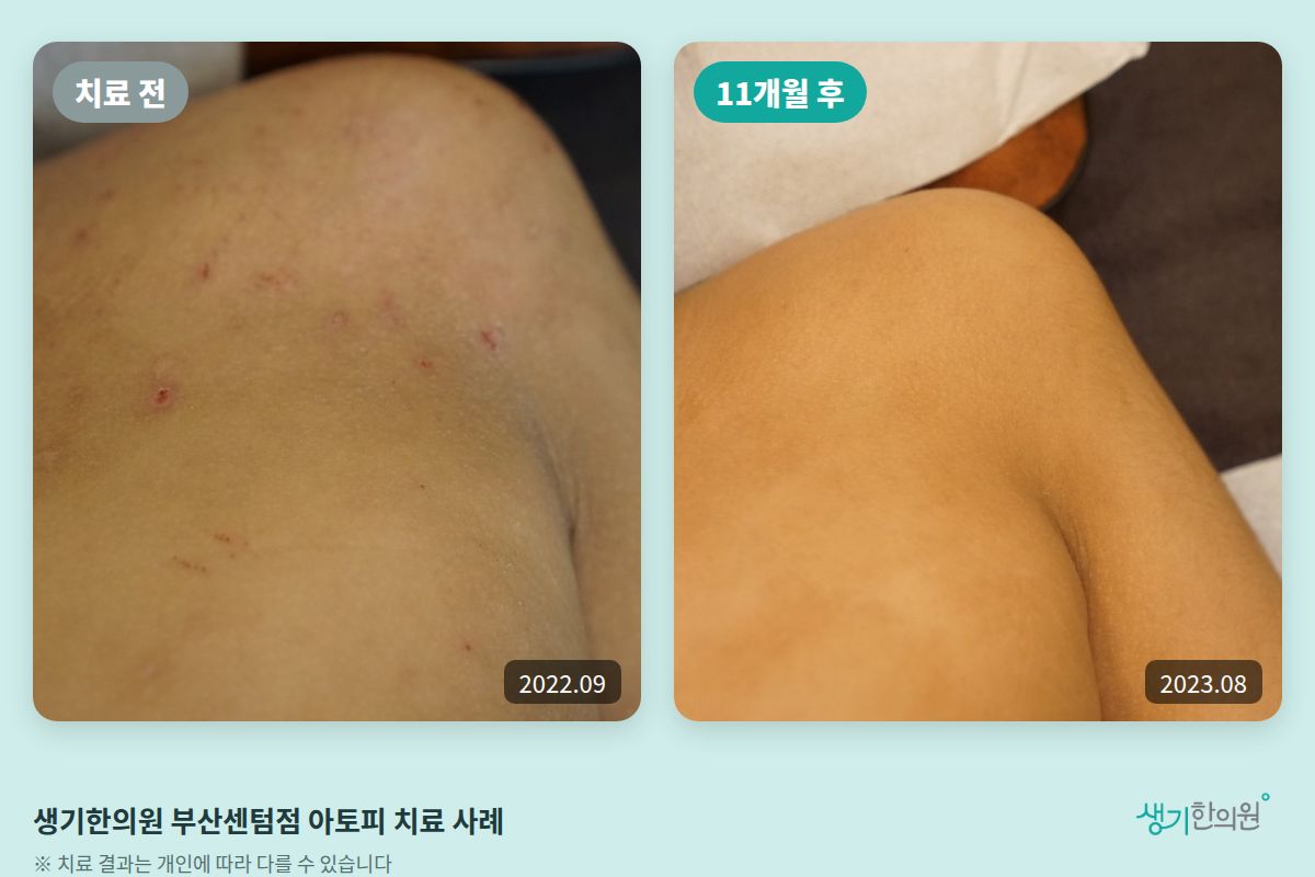 생기한의원 부산센텀점 아토피 치료 전(2022.09)과 11개월 후(2023.08) 비교 사진