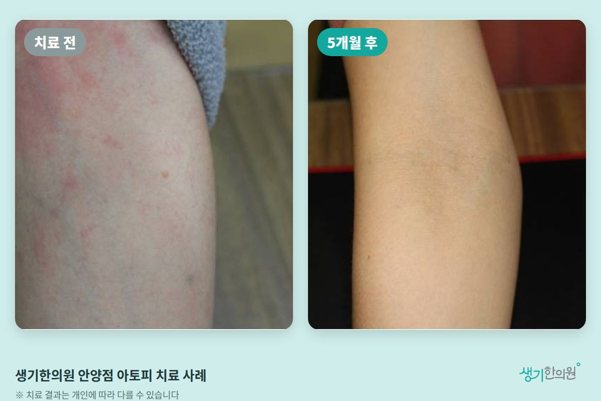 생기한의원 안양점 아토피 치료 전과 5개월 후 비교 사진
