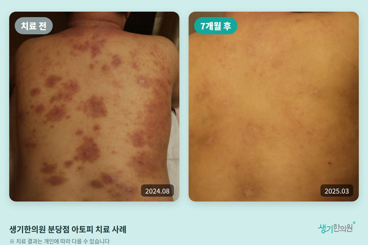 생기한의원 분당점 아토피 치료 전(2024.08)과 7개월 후(2025.03) 비교 사진