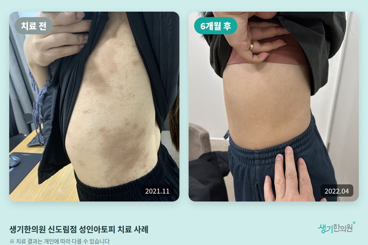 생기한의원 신도림점 성인아토피 치료 전(2021.11)과 6개월 후(2022.04) 등 비교 사진
