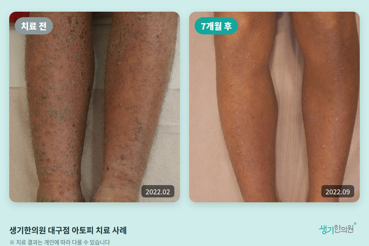 생기한의원 대구점 아토피 치료 전(2022.02)과 7개월 후(2022.09) 비교 사진