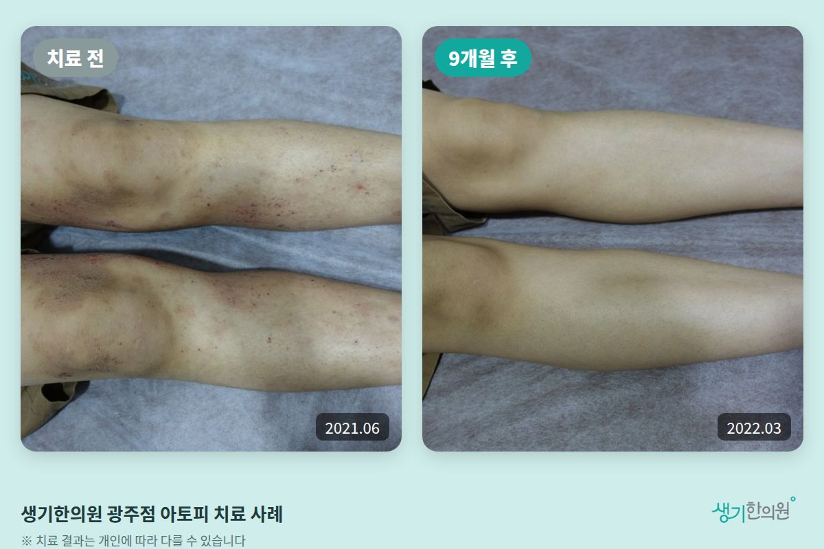 생기한의원 광주점 아토피 치료 전(2021.06)과 9개월 후(2022.03) 비교 사진