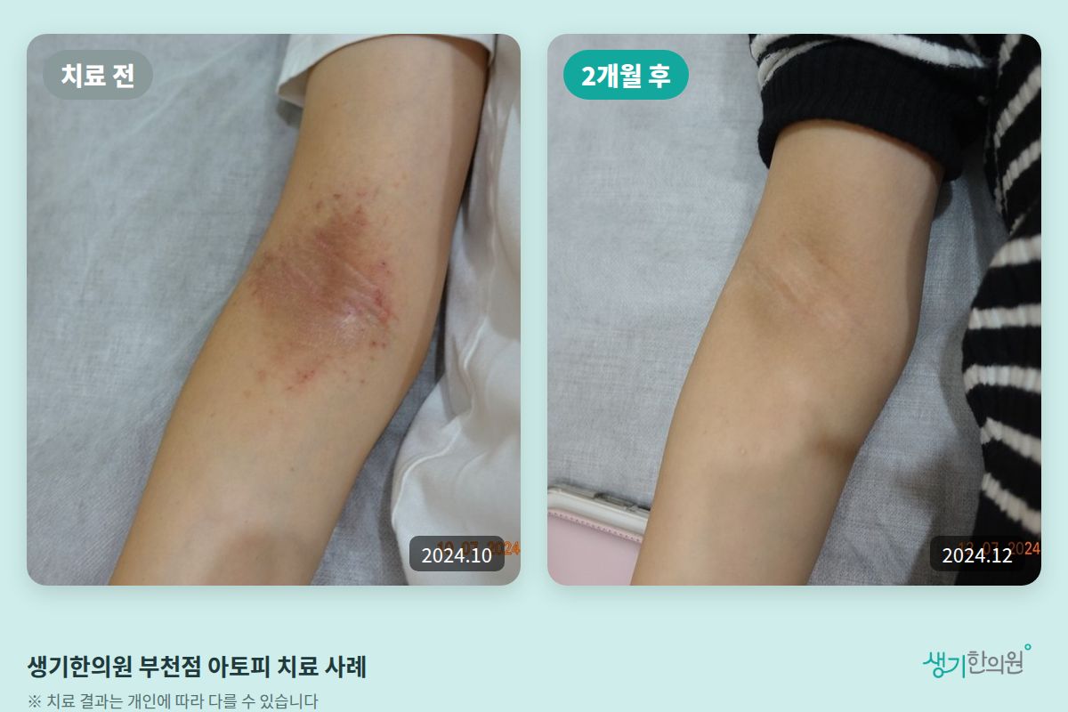 생기한의원 부천점 아토피 치료 전(2024.10)과 2개월 후(2024.12) 비교 사진