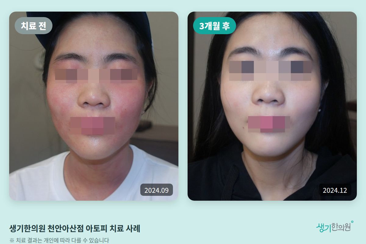 생기한의원 천안아산점 아토피 치료 전(2024.09)과 3개월 후(2024.12) 비교 사진