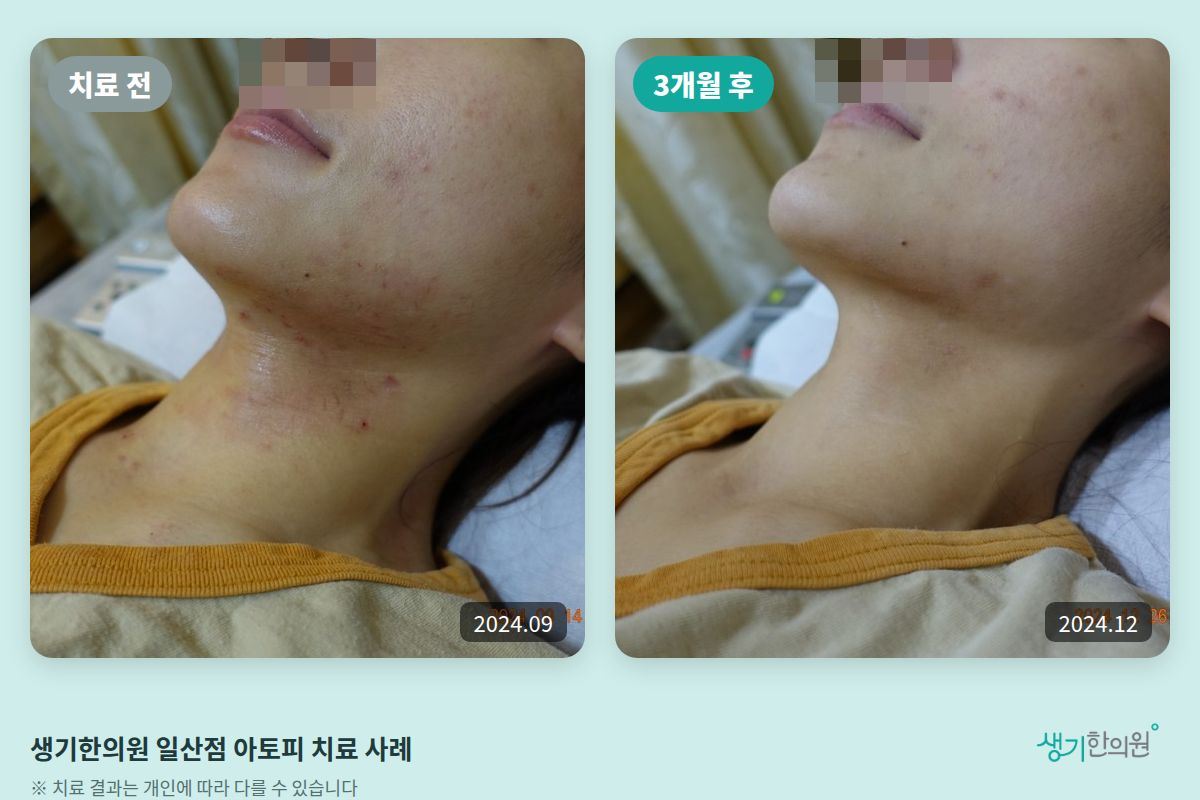 생기한의원 일산점 아토피 치료 전(2024.09)과 3개월 후(2024.12) 비교 사진