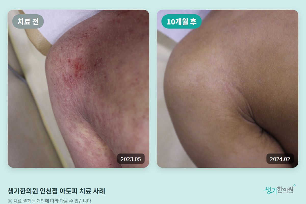 생기한의원 인천점 아토피 치료 전(2023.05)과 10개월 후(2024.02) 비교 사진