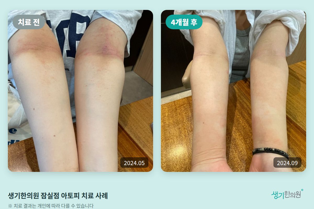 생기한의원 잠실점 아토피 치료 전(2024.05)과 4개월 후(2024.09) 비교 사진