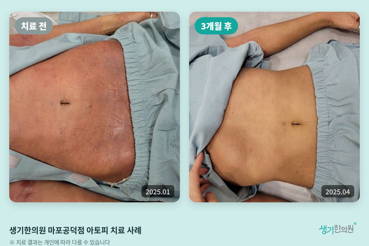 생기한의원 마포공덕점 아토피 치료 전(2025.01)과 3개월 후(2025.04) 비교 사진