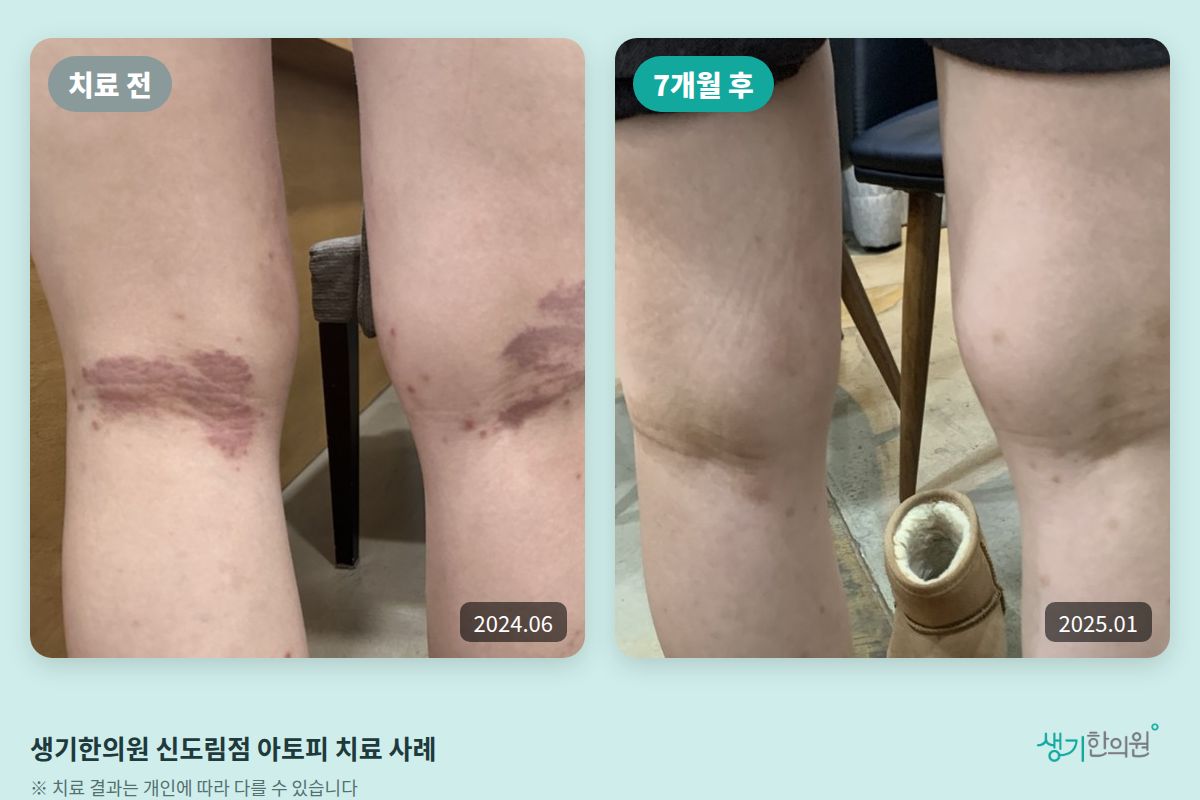 생기한의원 신도림점 아토피 치료 전(2024.06)과 7개월 후(2025.01) 비교 사진