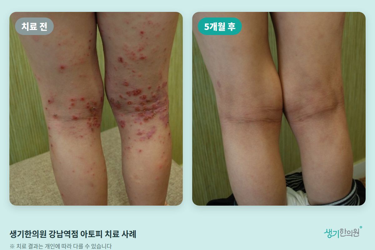 생기한의원 강남역점 아토피 치료 전과 5개월 후 비교 사진