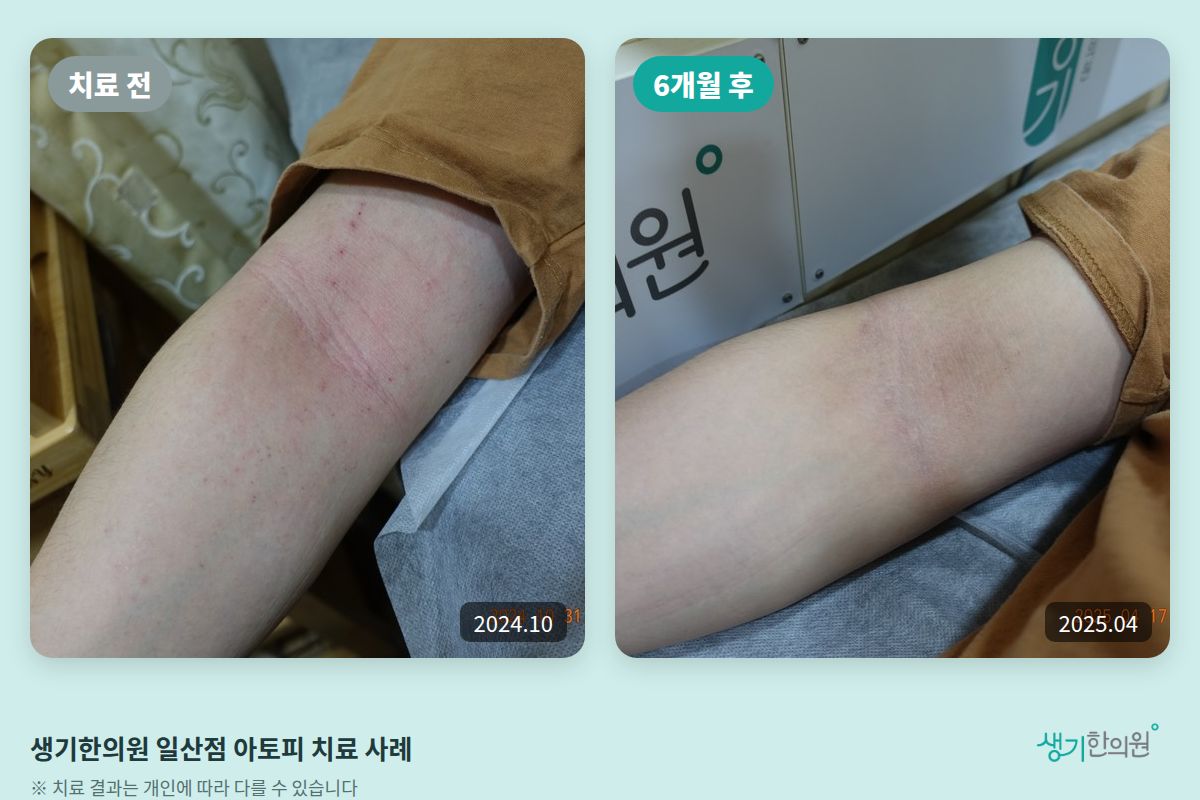 생기한의원 일산점 아토피 치료 전(2024.10)과 6개월 후(2025.04) 비교 사진