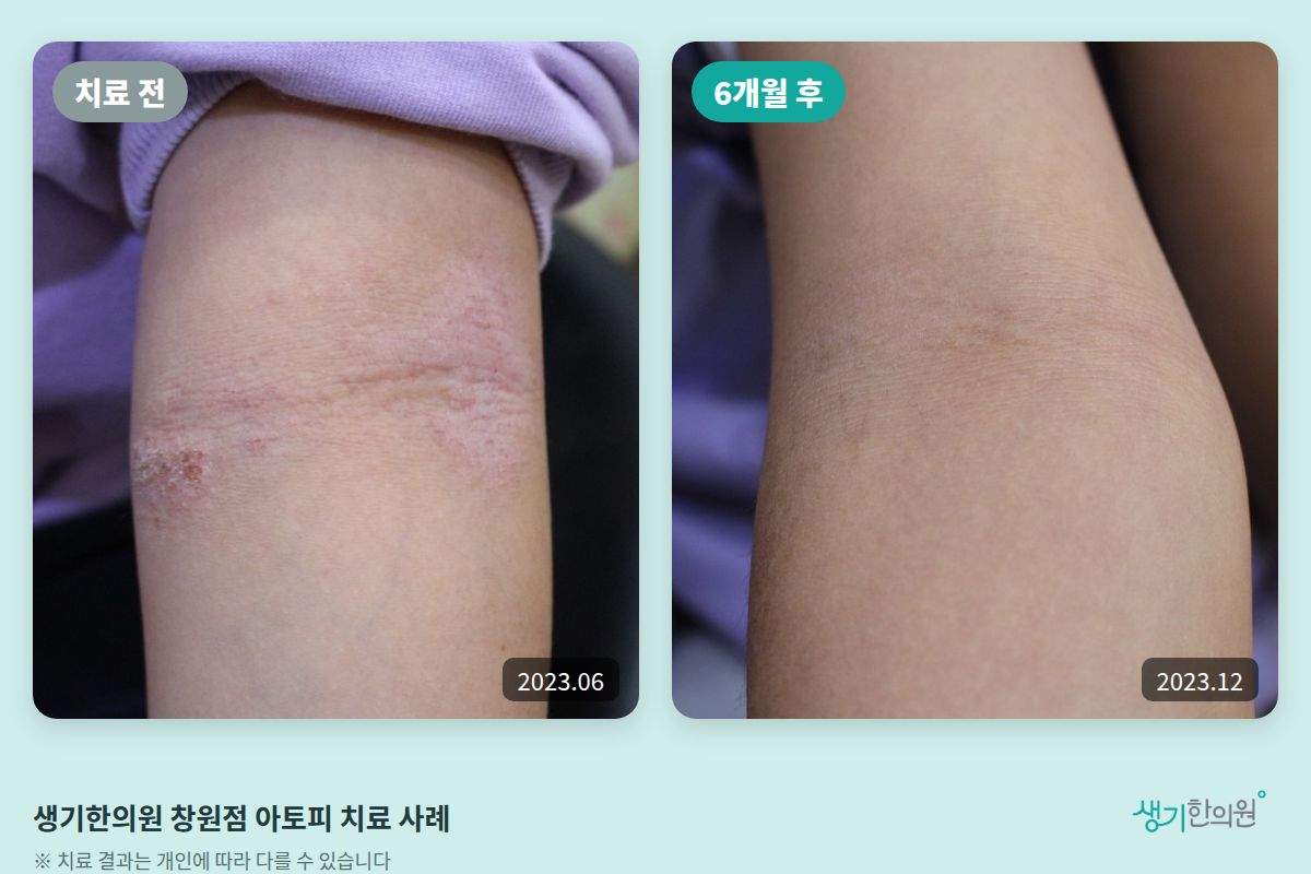 생기한의원 창원점 아토피 치료 전(2023.06)과 6개월 후(2023.12) 비교 사진