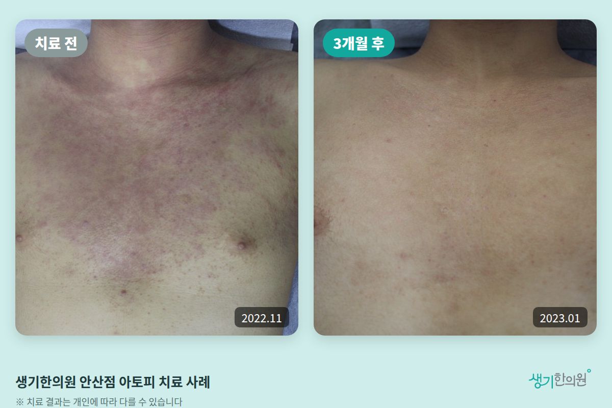 생기한의원 안산점 아토피 치료 전(2022.11)과 3개월 후(2023.01) 비교 사진