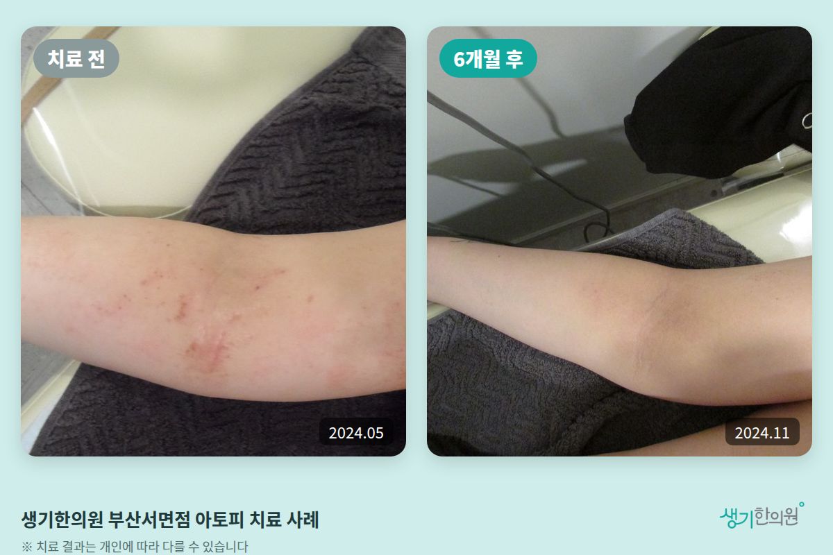 생기한의원 부산서면점 아토피 치료 전(2024.05)과 6개월 후(2024.11) 비교 사진