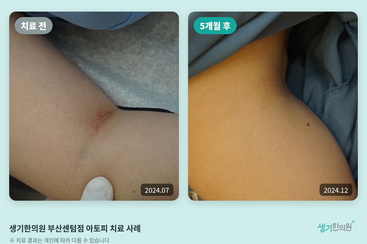 생기한의원 부산센텀점 아토피 치료 전(2024.07)과 5개월 후(2024.12) 비교 사진