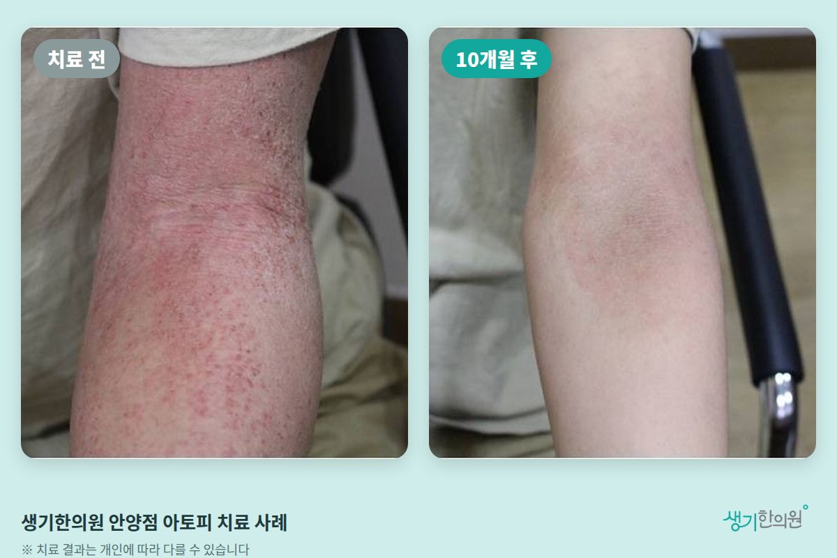 생기한의원 안양점 아토피 치료 전과 10개월 후 비교 사진