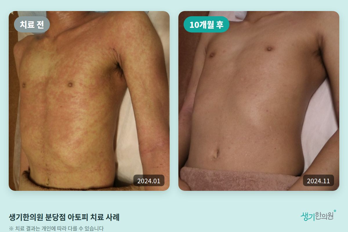 생기한의원 분당점 아토피 치료 전(2024.01)과 10개월 후(2024.11) 비교 사진