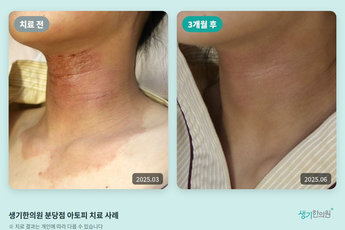 생기한의원 분당점 아토피 치료 전(2025.03)과 3개월 후(2025.06) 목 부위 비교 사진
