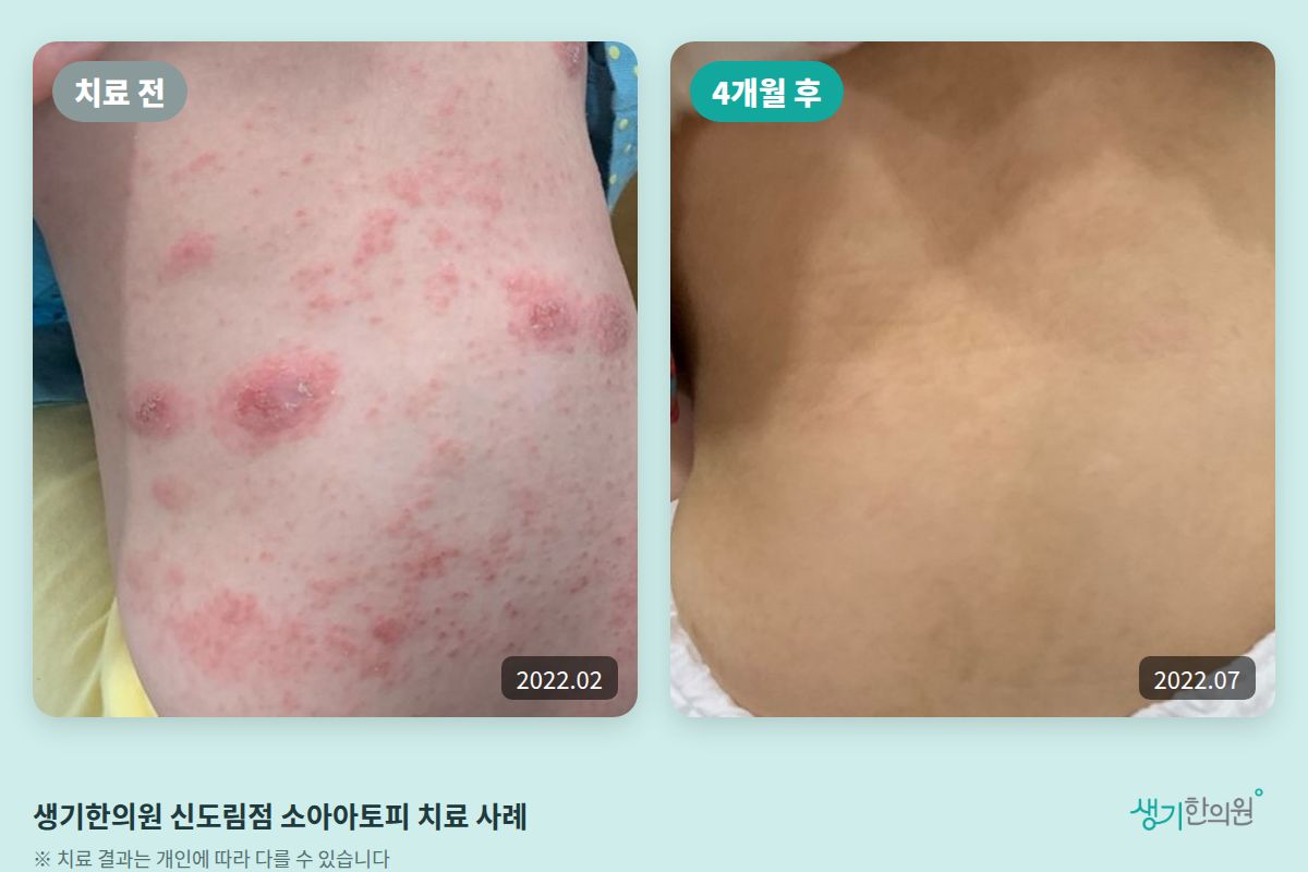 생기한의원 신도림점 소아아토피 치료 전(2022.02)과 4개월 후(2022.07) 비교 사진