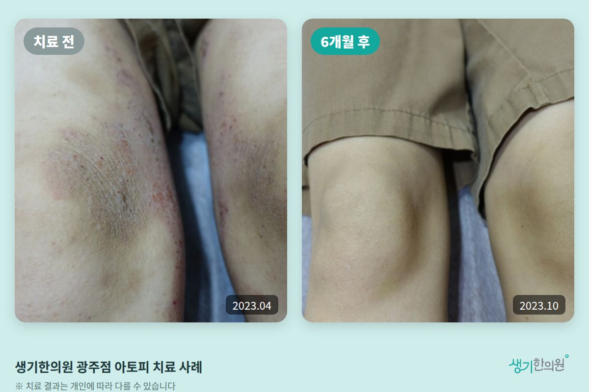 생기한의원 광주점 아토피 치료 전(2023.04)과 6개월 후(2023.10) 비교 사진