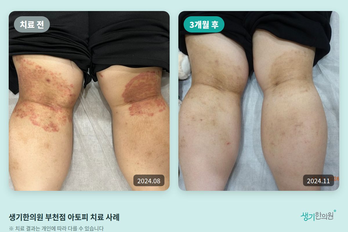 생기한의원 부천점 아토피 치료 전(2024.08)과 3개월 후(2024.11) 비교 사진