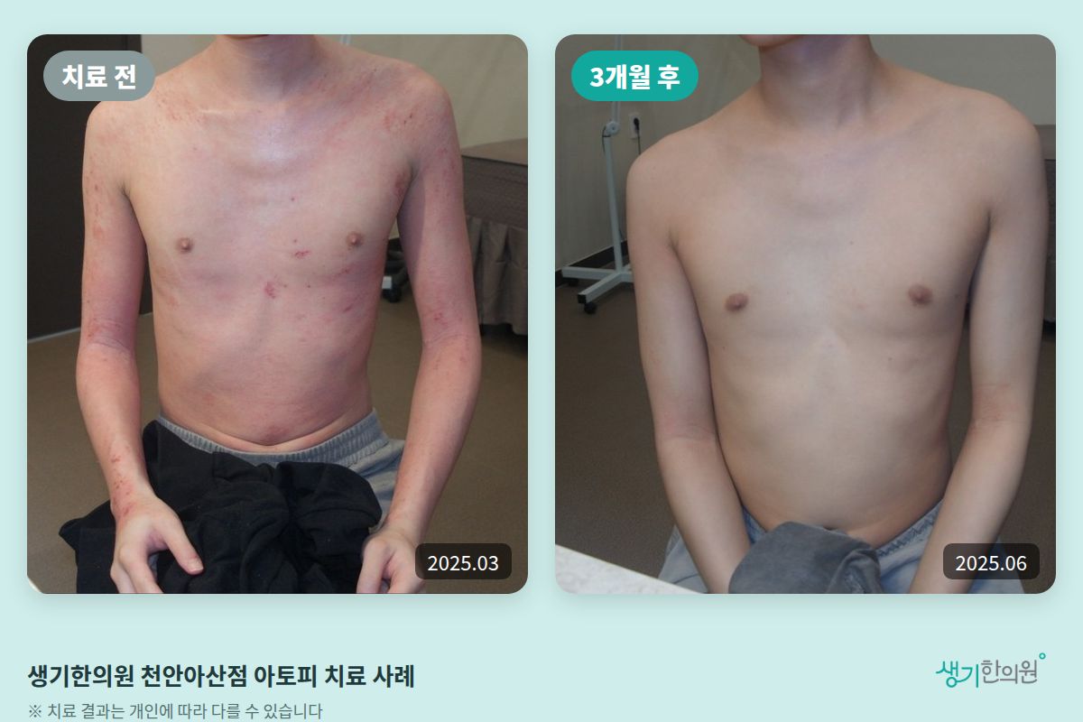 생기한의원 천안아산점 아토피 치료 전(2025.03)과 3개월 후(2025.06) 비교 사진