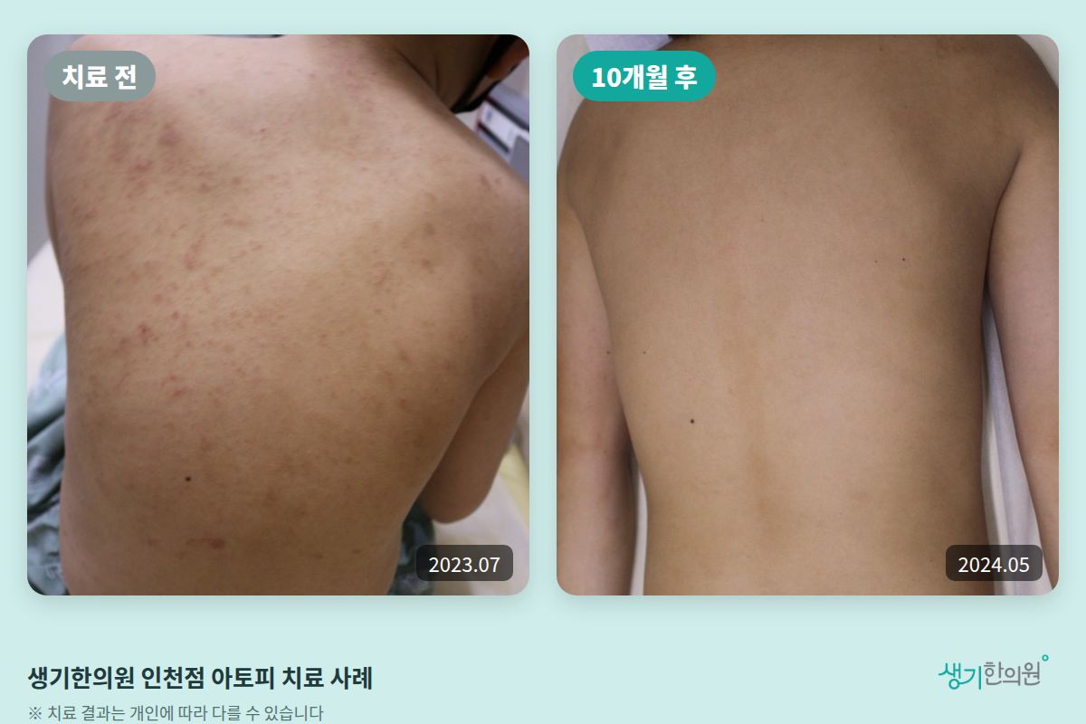 생기한의원 인천점 아토피 치료 전(2023.07)과 10개월 후(2024.05) 비교 사진