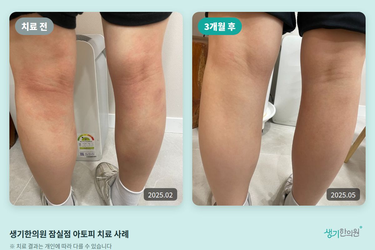 생기한의원 잠실점 아토피 치료 전(2025.02)과 3개월 후(2025.05) 비교 사진