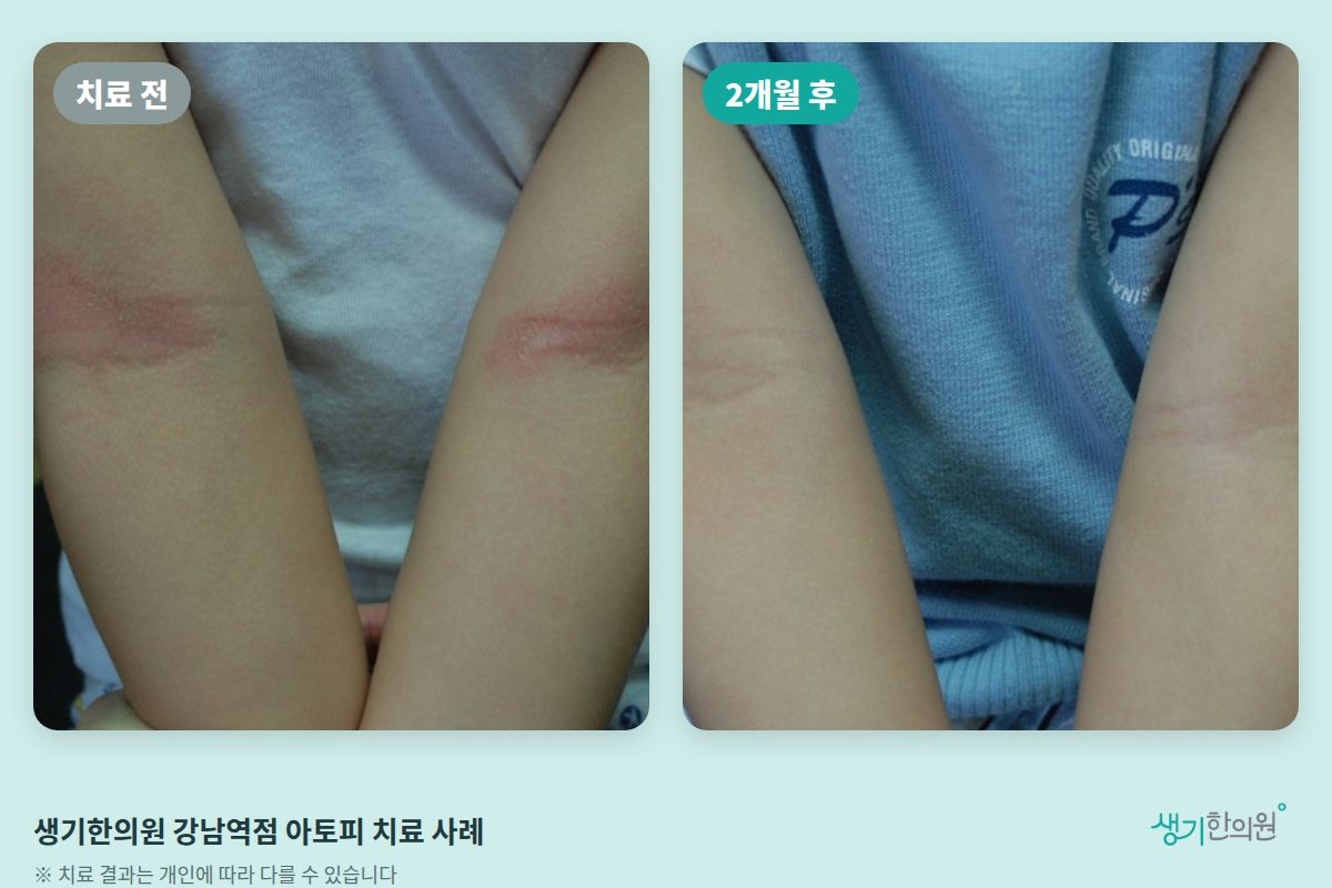 생기한의원 강남역점 아토피 치료 전과 2개월 후 비교 사진