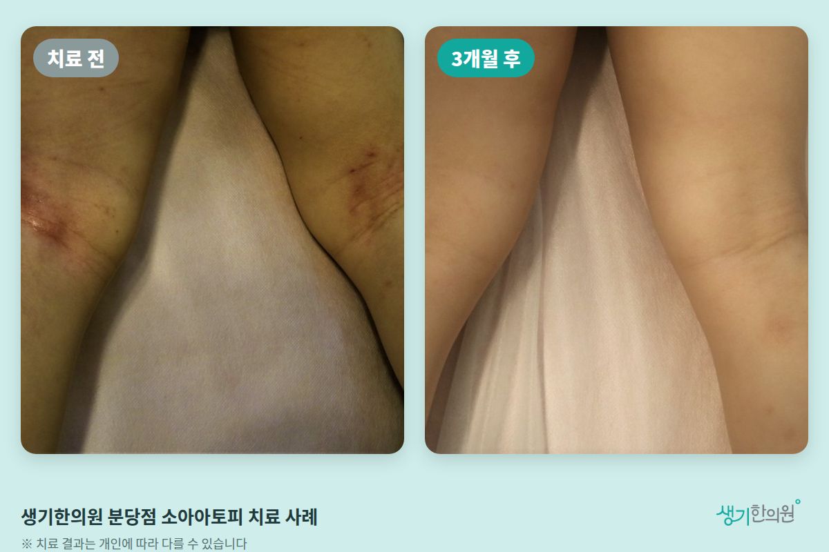 생기한의원 분당점 소아아토피 치료 전과 3개월 후 비교 사진